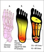 Plantar-Fasciitis-Pain-Areas