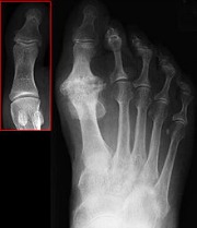 big toe joint x-ray